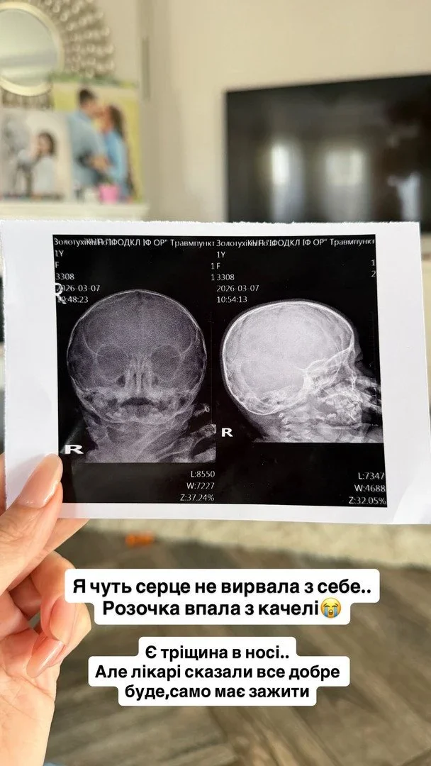 Травма носа у дитини Юлії Верби: деталі інциденту на дитячому майданчику